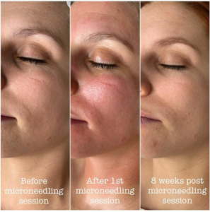 Microneedling